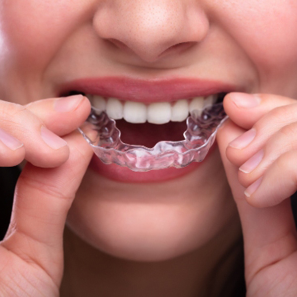 Teeth Grinding Relief Treatment in Santa Barbara, CA