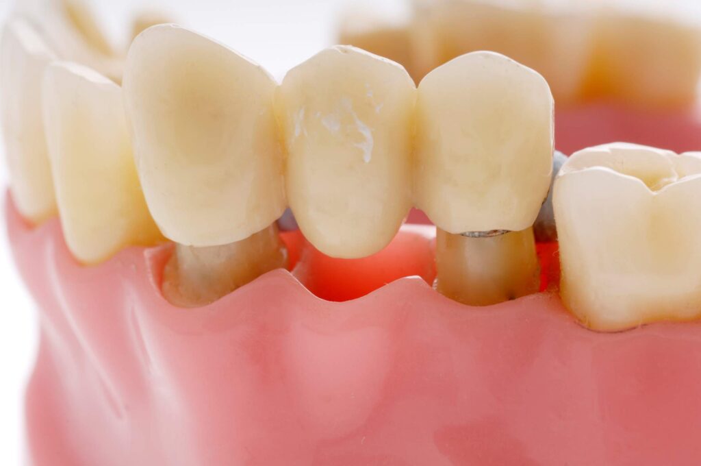 Dental bridge supported by implants on a model in Santa Barbara, CA