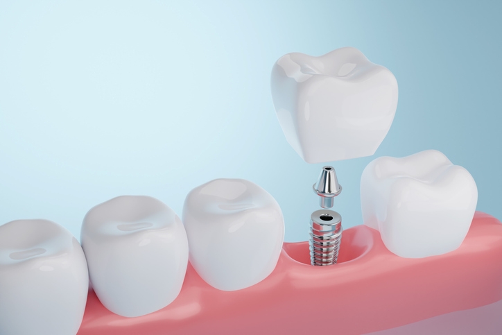 Dental implant with crown placement model for bridges and dentures Santa Barbara, CA