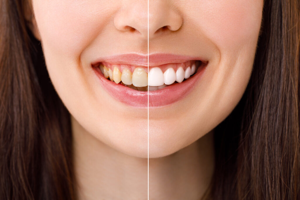 Smiling woman before and after the teeth whitening procedure in Santa Barbara, CA